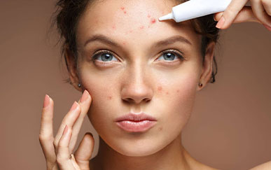 acne treatment