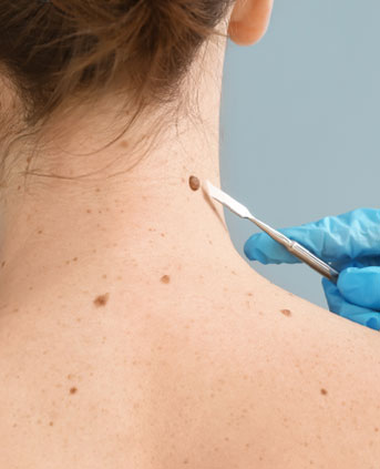mole and wart remover 1